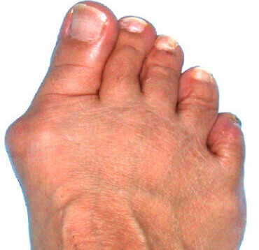 Foot with bunion