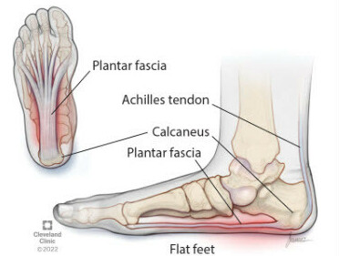 Plantar fasciitis